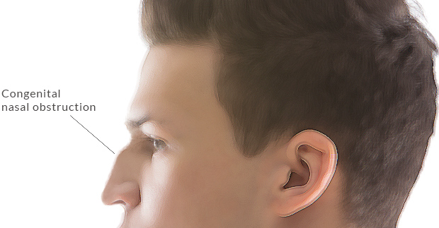 Functional Septorhinoplasty functional rhinoplasty nz