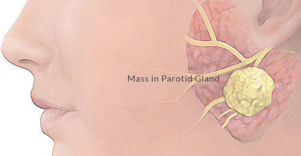 parotidectomy - parotid salivary gland surgery